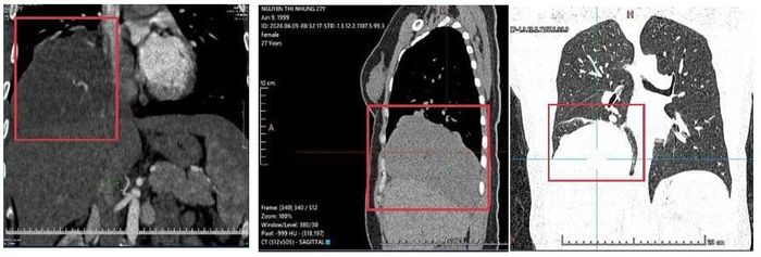 Hình ảnh CT lồng ngực cho thấy khối tổn thương lớn nằm sát cơ hoành phải với hệ thống cấp máu bất thường. (Nguồn: Bệnh viện Phổi 74).