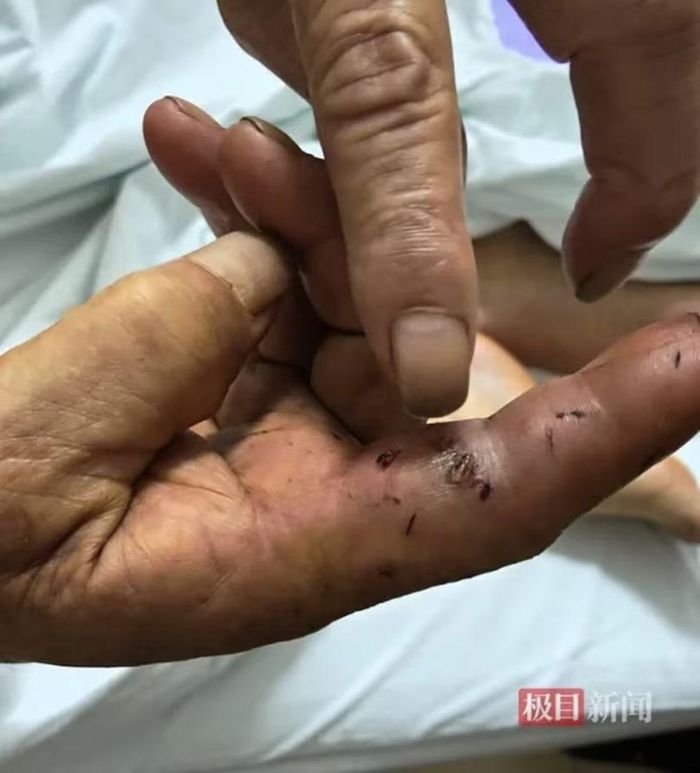 Một người dân bị rắn cắn, được cứu chữa kịp thời. Ảnh: Jimu.