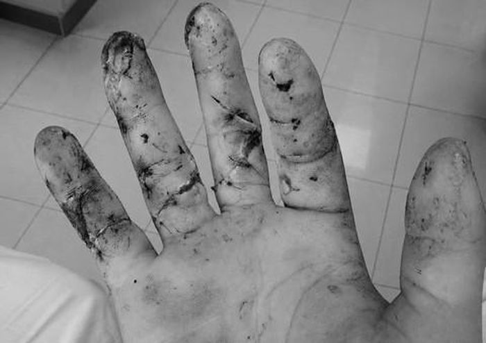 Ba ngón tay được bảo tồn thành công sau gần 10 giờ vi phẫu.