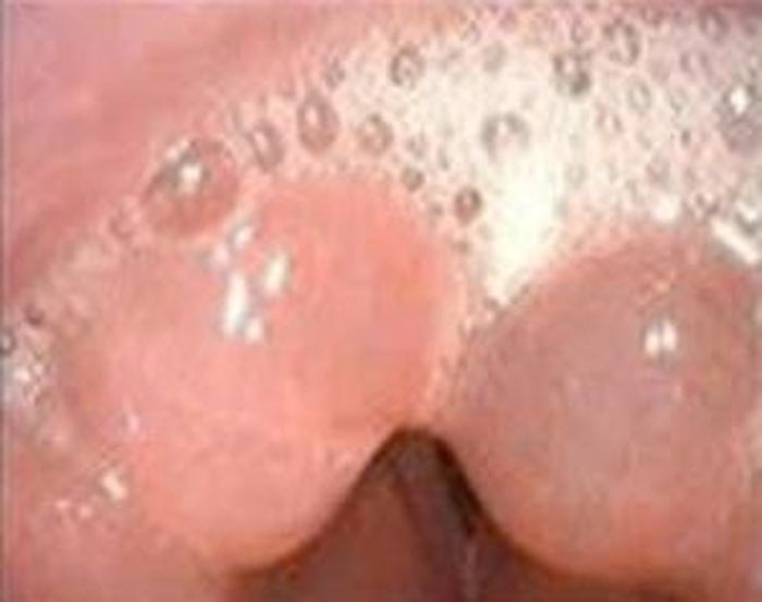  Cổ họng sưng của bệnh nhân. Ảnh: BVCC.
