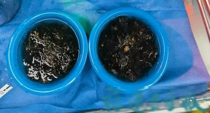 Lượng tóc lấy ra được cho biết nhiều đến mức có thể lấp đầy hai chậu lớn. Ảnh: Tin tức y tế Phúc Kiến.