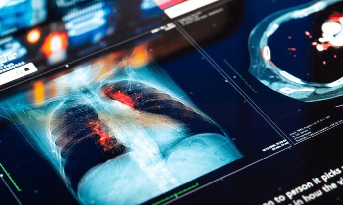 Hình ảnh chụp cộng hưởng từ (MRI) để chẩn đoán ung thư phổi. Ảnh: da-kuk/Getty Images