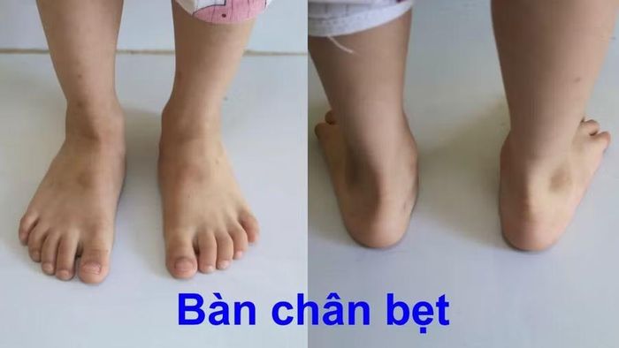 Bác sĩ thăm khám, đánh giá tình trạng bàn chân bẹt ở trẻ em. Ảnh: Bệnh viện 1A