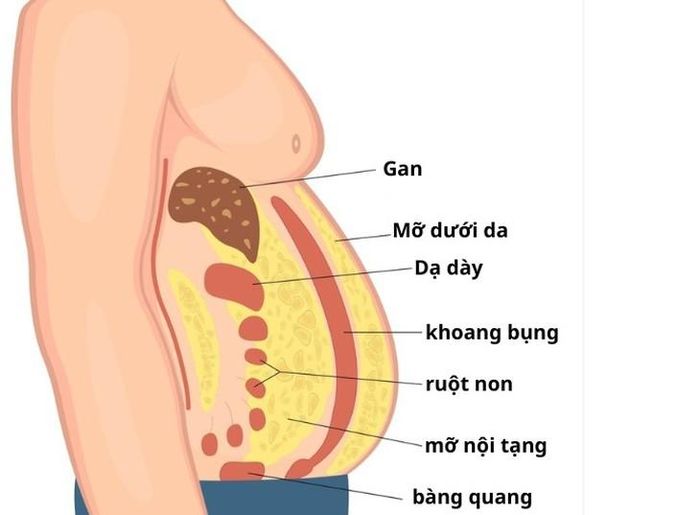 Quá nhiều mỡ nội tạng làm tăng nguy cơ mắc nhiều bệnh mạn tính nguy hiểm.