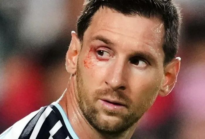 Messi bị rách mí mắt sau một pha tranh chấp bóng với Xhaka. Ảnh: EFE