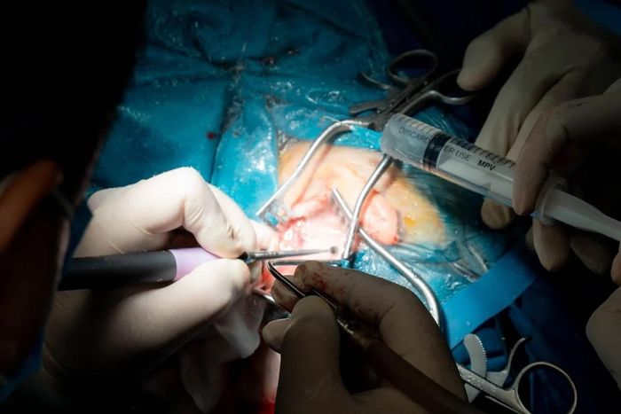 Ca phẫu thuật thành công, không chỉ mang ý nghĩa đối với riêng bệnh nhi mà còn mở ra cơ hội điều trị cho nhiều trẻ điếc bẩm sinh khác. Ảnh: BVNHN.