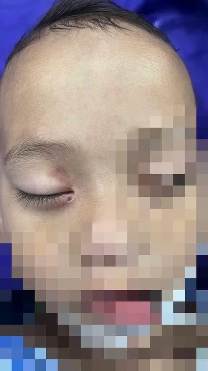 Tổn thương của bệnh nhi.