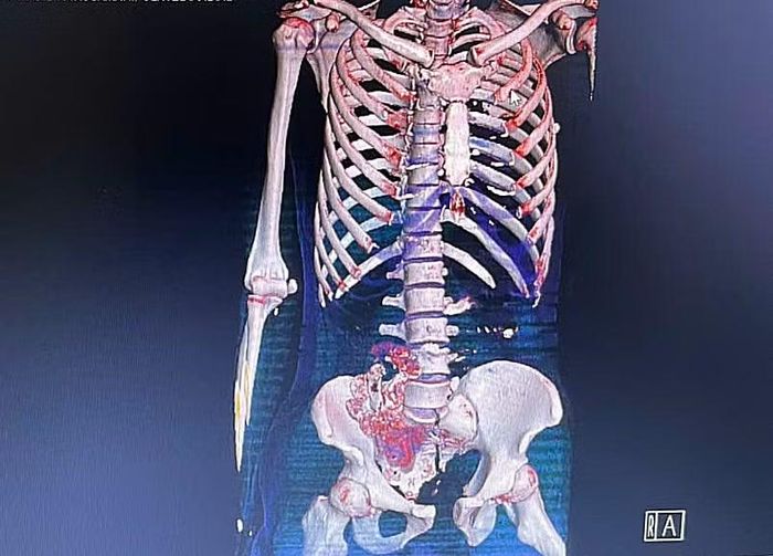 Hình ảnh tổn thương trên phim chụp - Ảnh BVCC