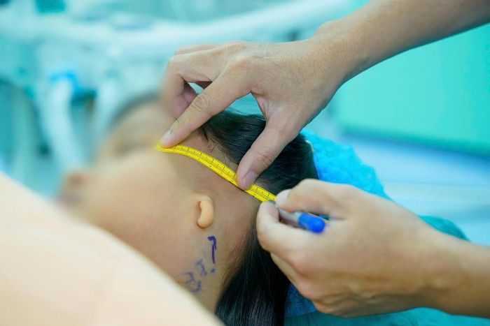 Người bệnh được đo đạc, đánh giá cấu trúc vùng tai trước phẫu thuật tạo hình tai nhỏ