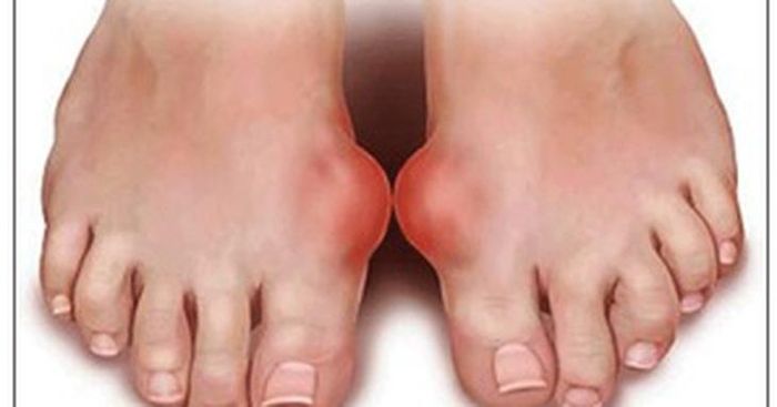 Người bệnh mắc gout mạn tính nhiều năm với nhiều hạt tophi lớn.