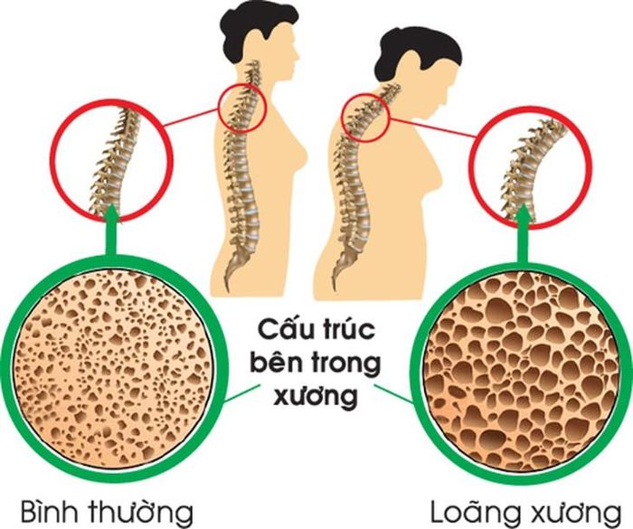 Loãng xương đặc trưng bởi sự suy giảm khối lượng và mật độ xương, khiến xương trở nên giòn, dễ gãy.