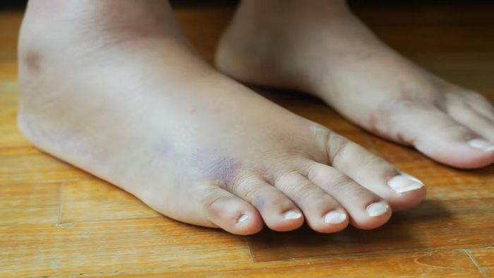  Vàng da hoặc vàng mắt là một trong những dấu hiệu kinh điển cảnh báo chức năng gan đang suy giảm. Ảnh: TOI. 