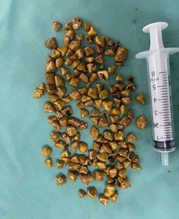 Sỏi mật như ngô. Ảnh BVCC.