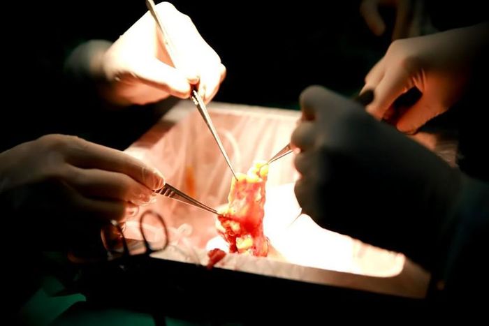 Ca ghép thận kéo dài 3 giờ liền, với sự phối hợp nhịp nhàng, chính xác của nhiều bộ phận. Ảnh: Bệnh viện cung cấp