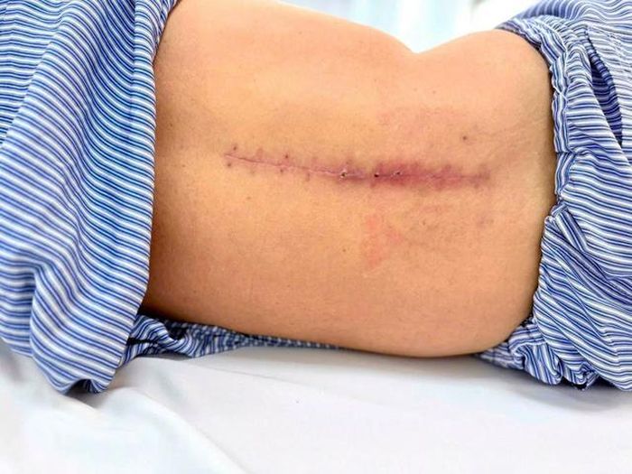 Bệnh nhân 62 tuổi chấn thương cột sống sau cú ngã từ độ cao khoảng 3 mét.