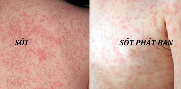 Phân biệt sởi và sốt phát ban