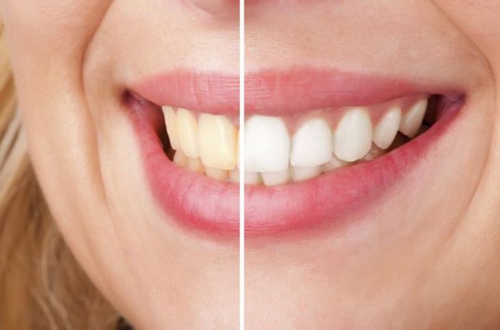 Tẩy trắng răng đang trở thành phương pháp thẩm mỹ nha khoa được nhiều người lựa chọn.