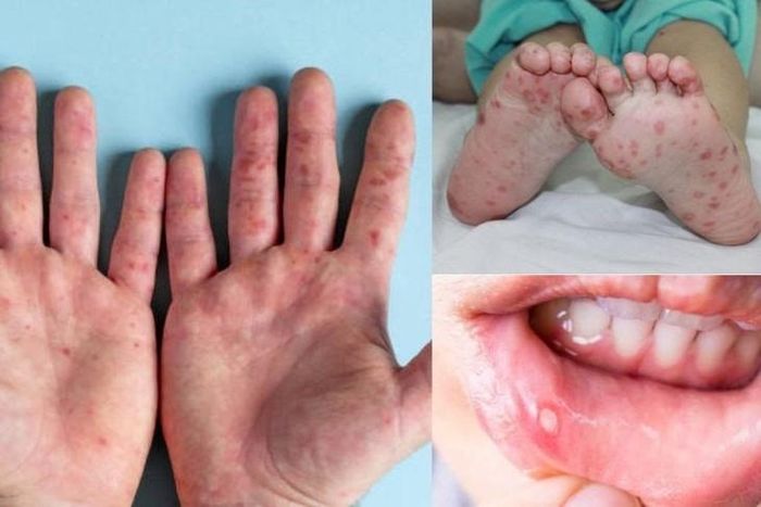Các dấu hiệu của bệnh chân tay miệng.