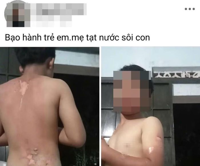 Hình ảnh được cho là một bé trai ở xã Ea Đrăng nghi bị mẹ tạt nước sôi lên người.