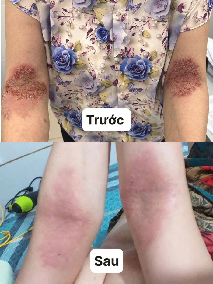 Các vùng da ở nếp gấp bị trợt loét, rỉ dịch kéo dài khiến người bệnh phải chịu đựng đau đớn suốt nhiều năm. Ảnh: BVCC