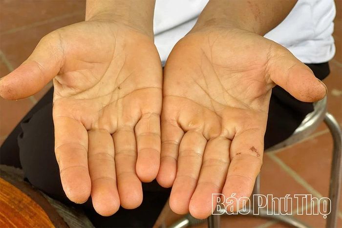 Đôi bàn tay vàng như nghệ cũng những vết sứt sẹo khi đi cắt sơn của người phụ nữ Thọ Văn.