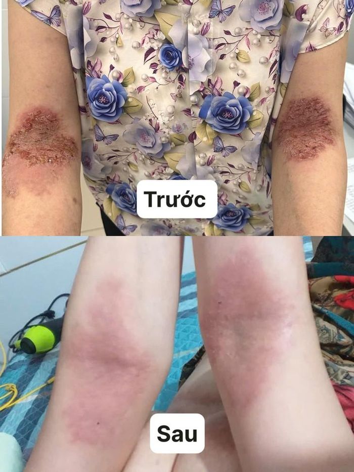 Hình ảnh tổn thương trên da do bệnh Hailey-Hailey trước và sau của bệnh nhân. Ảnh: BVCC