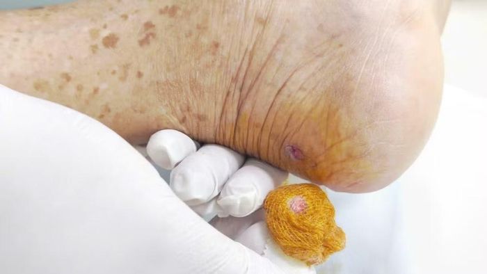 Vết thương nhỏ ở gót chân suýt cướp đi tính mạng người bệnh.