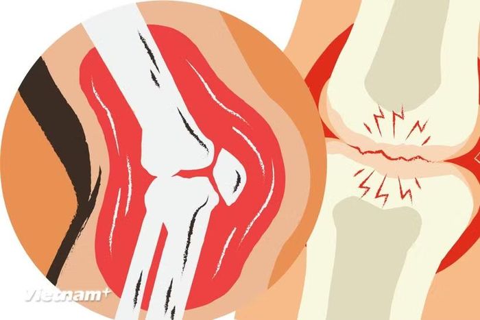 Ung thư xương ác tính là một dạng ung thư xương hiếm gặp. (Nguồn: Vietnam+)