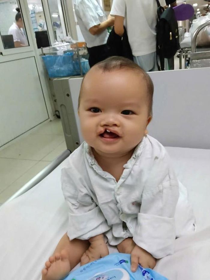 Bé Hồ Văn Minh bị dị tật cần phẫu thuật tạo hình môi