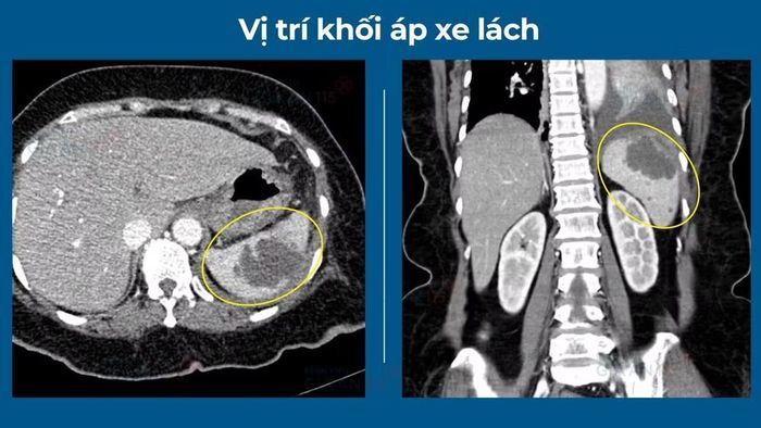 Vị trí khối áp xe lách.