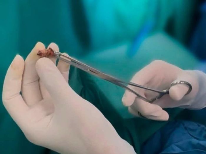 Mong chữa bệnh trĩ nhanh để không ảnh hưởng công việc, người đàn ông 64 tuổi chọn đốt trĩ tại phòng khám tư. Hai tháng sau, ông phải phẫu thuật vì biến chứng nặng. Ảnh: BVCC.