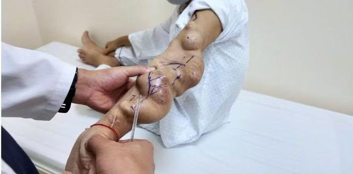 Các khối phình phát triển liên tiếp trên cầu nối AVF khiến cánh tay biến dạng, thành mạch căng mỏng và dọa vỡ bất cứ lúc nào.