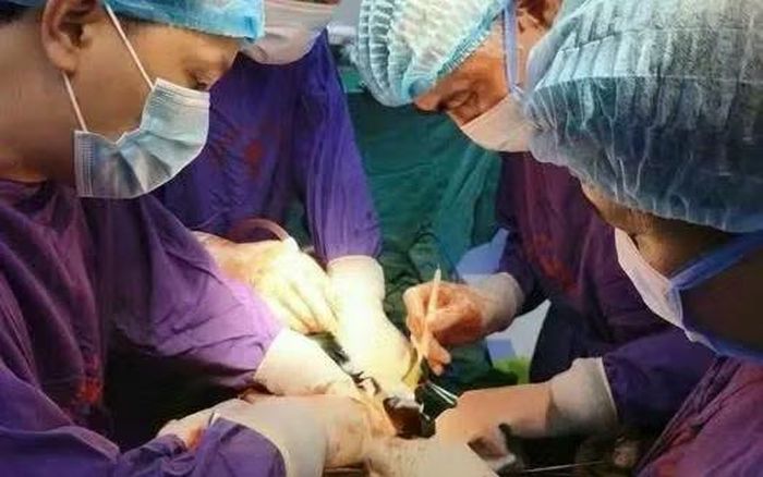 Phẫu thuật thành công khối u gan lớn cho bệnh nhân. Ảnh Bệnh viện 19/8