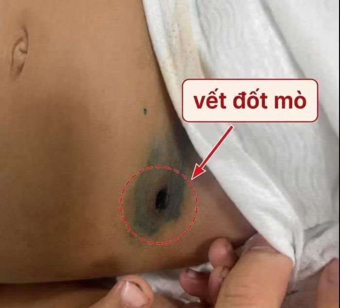 Phát hiện bệnh nhờ vết đốt mò - Ảnh BVCC