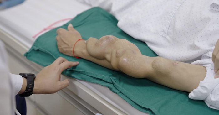 Nam bệnh nhân nhập viện với cánh tay biến dạng do chạy thận nhân tạo nhiều năm.