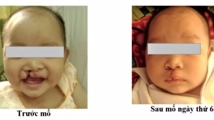 Một số hình ảnh người bệnh được phẫu thuật tại Bệnh viện Sản Nhi Nghệ An. (Ảnh: Bệnh viện cung cấp)