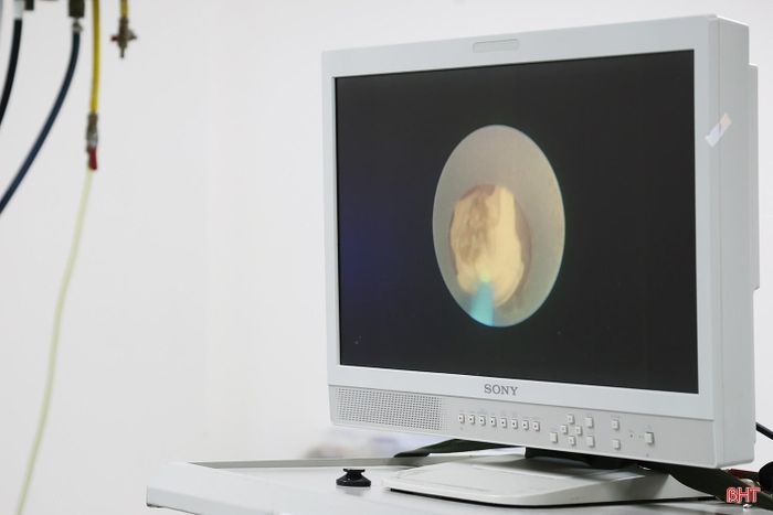 Laser công suất cao tiếp cận và phá vỡ khối sỏi ở thận.