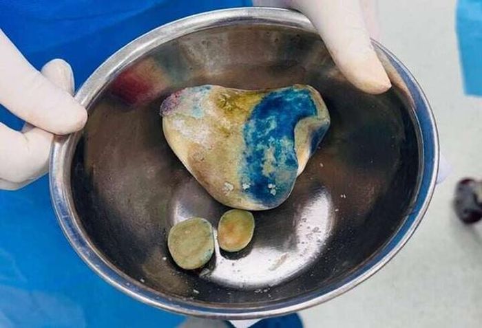 Viên sỏi nặng gần nửa kg trong bàng quang người đàn ông. Ảnh: BSCC.