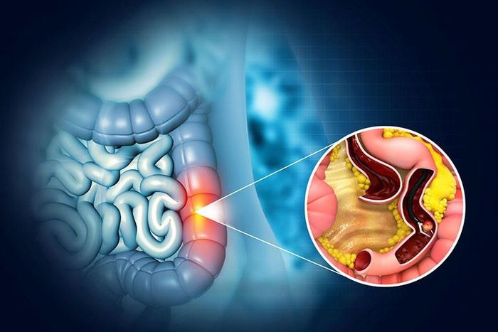 Người mang hội chứng Lynch có nguy cơ mắc ung thư đại trực tràng lên tới khoảng 80% và ung thư nội mạc tử cung khoảng 60% trong suốt cuộc đời. Ảnh minh họa