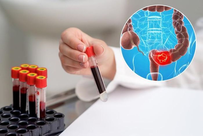 Sàng lọc phát hiện sớm ung thư đại trực tràng làm tăng khả năng điều trị khỏi bệnh.
