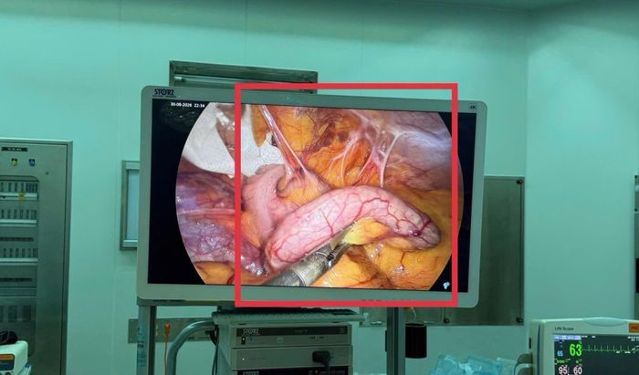  Không đau dữ dội, chỉ sốt nhẹ và đau bụng âm ỉ, người đàn ông vẫn mắc viêm ruột thừa cấp. Ảnh: BVCC. 