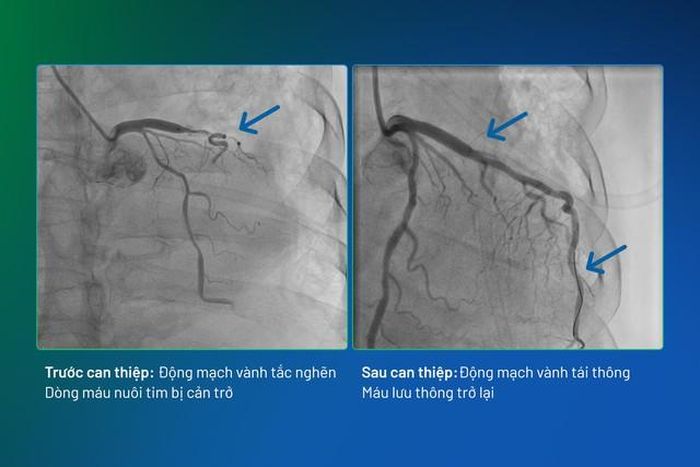 Hình ảnh động mạch vành trước và sau can thiệp của bệnh nhân (Ảnh: BVCC).