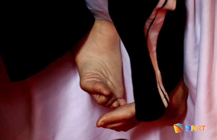 Đôi bàn chân của một nạn nhân da cam bị queo quắp. Ảnh: TRỌNG HUY