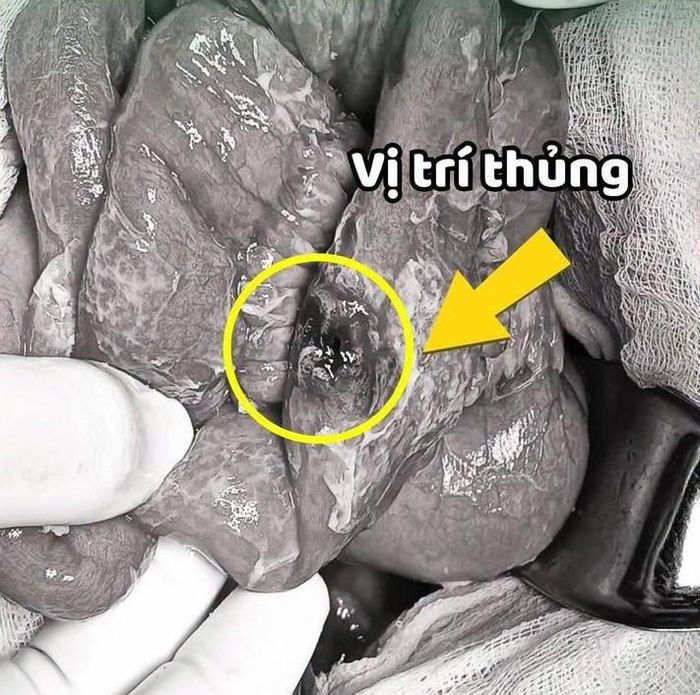 Người bệnh nhập viện trong tình trạng sốc nhiễm khuẩn nặng do thủng tạng rỗng. Ảnh: BVCC