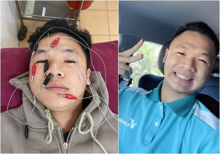 Ninh từng được chẩn đoán bị liệt dây thần kinh số 7. (Ảnh: NVCC)
