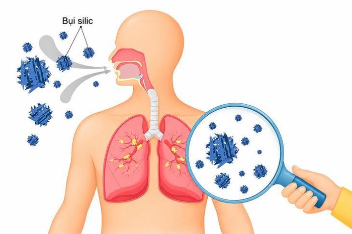 Bệnh bụi phổi silic là ví dụ điển hình cho tính chất "âm thầm tích lũy" của bệnh nghề nghiệp. Ảnh AI.