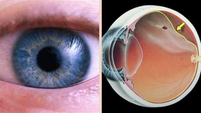 Cận thị là nguyên nhân khiến nhìn đồ vật xa bị mờ nhòe.