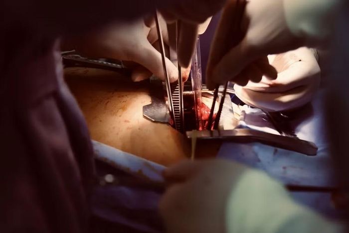 Kỹ thuật phẫu thuật tạo hình phế quản (Sleeve) giúp loại bỏ khối u đồng thời bảo tồn tối đa nhu mô phổi và chức năng hô hấp cho người bệnh.