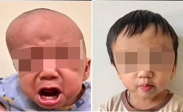 Kết quả sau 2 năm điều trị bằng phương pháp kéo giãn phức hợp trán-ổ mắt của một bệnh nhi tại khoa Sọ mặt và Tạo hình, Bệnh viện Nhi Trung ương.