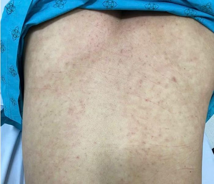 Ban sởi trên lưng bệnh nhân - Ảnh BVCC